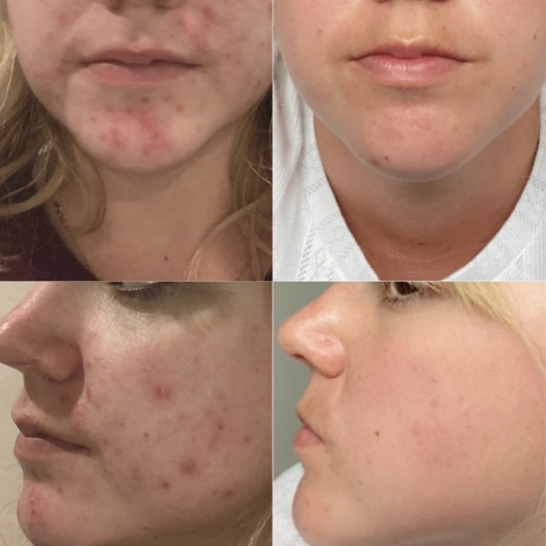 Best skincare for oily skin - Sabbia Co