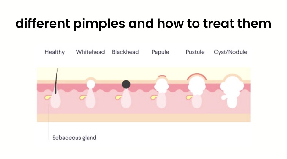 Pimples Example How to identify and treat different types of pimples – Sabbia Co